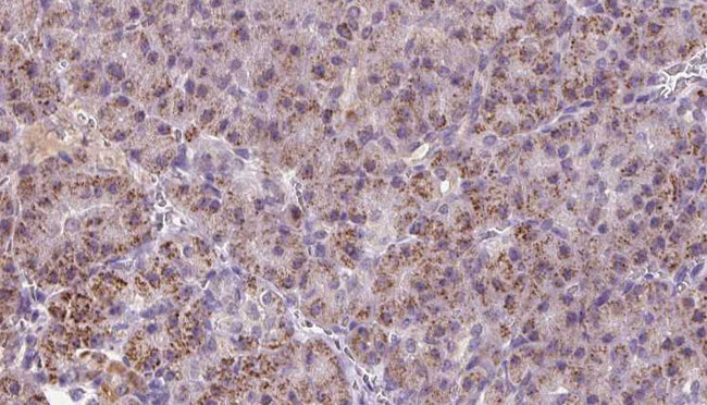 HBS1L Antibody - 1:100 staining human pancreas carcinoma tissue by IHC-P. The sample was formaldehyde fixed and a heat mediated antigen retrieval step in citrate buffer was performed. The sample was then blocked and incubated with the antibody for 1.5 hours at 22°C. An HRP conjugated goat anti-rabbit antibody was used as the secondary.