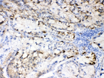 HBV / Hepatitis B Virus Antibody - IHC testing of FFPE human liver cancer tissue with Hepatitis B Virus antibody at 0.5ug/ml. HIER: steam section in pH6 citrate buffer for 20 min and allow to cool prior to testing.