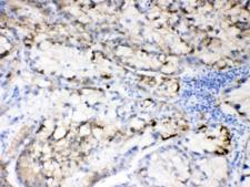 HBV / Hepatitis B Virus Antibody - IHC testing of FFPE human liver cancer tissue with Hepatitis B Virus antibody at 0.5ug/ml. HIER: steam section in pH6 citrate buffer for 20 min and allow to cool prior to testing.
