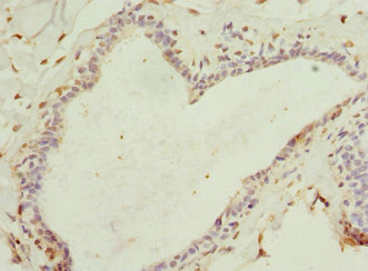 HBXIP Antibody - Immunohistochemistry of paraffin-embedded human breast cancer at dilution 1:100