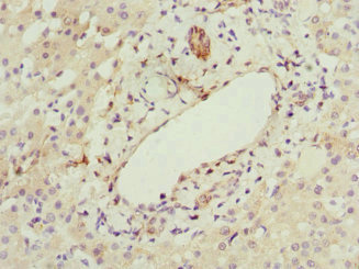 HBXIP Antibody - Immunohistochemistry of paraffin-embedded human liver cancer at dilution 1:100
