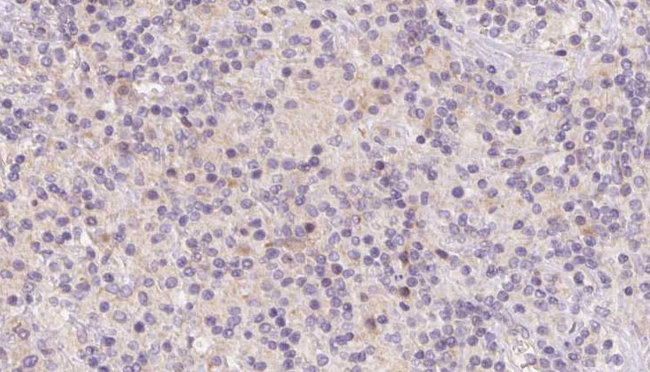 HBXIP Antibody - 1:100 staining human lymph carcinoma tissue by IHC-P. The sample was formaldehyde fixed and a heat mediated antigen retrieval step in citrate buffer was performed. The sample was then blocked and incubated with the antibody for 1.5 hours at 22°C. An HRP conjugated goat anti-rabbit antibody was used as the secondary.