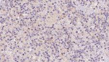 HBXIP Antibody - 1:100 staining human lymph carcinoma tissue by IHC-P. The sample was formaldehyde fixed and a heat mediated antigen retrieval step in citrate buffer was performed. The sample was then blocked and incubated with the antibody for 1.5 hours at 22°C. An HRP conjugated goat anti-rabbit antibody was used as the secondary.