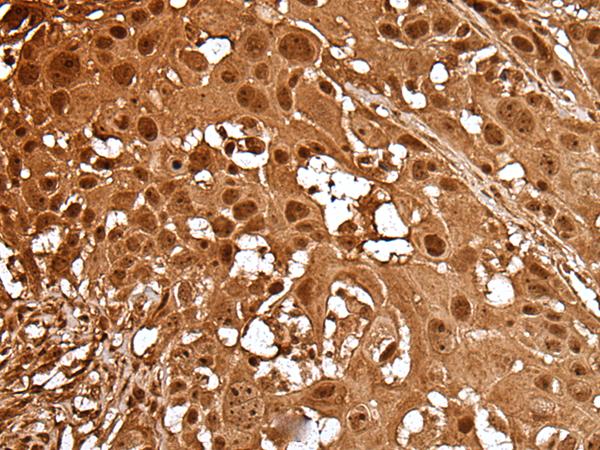 HBXIP Antibody - Immunohistochemistry of paraffin-embedded Human esophagus cancer tissue  using LAMTOR5 Polyclonal Antibody at dilution of 1:35(×200)