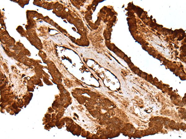 HBXIP Antibody - Immunohistochemistry of paraffin-embedded Human thyroid cancer tissue  using LAMTOR5 Polyclonal Antibody at dilution of 1:55(×200)