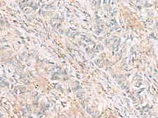 HBZ Antibody - Immunohistochemistry of paraffin-embedded Human ovarian cancer tissue  using HBZ Polyclonal Antibody at dilution of 1:120(×200)