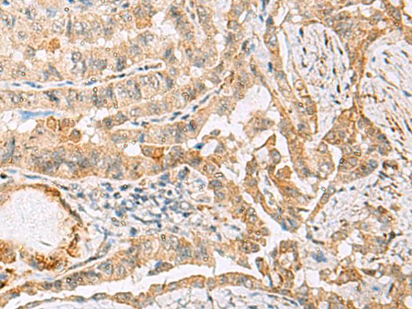HBZ Antibody - Immunohistochemistry of paraffin-embedded Human thyroid cancer tissue  using HBZ Polyclonal Antibody at dilution of 1:120(×200)