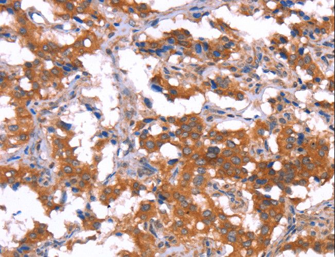 HCAR2 / NIACR1 Antibody - Immunohistochemistry of paraffin-embedded Human thyroid cancer using HCAR2 Polyclonal Antibody at dilution of 1:40.