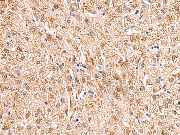 HCCS Antibody - Immunohistochemistry of paraffin-embedded Human liver cancer tissue  using HCCS Polyclonal Antibody at dilution of 1:110(×200)