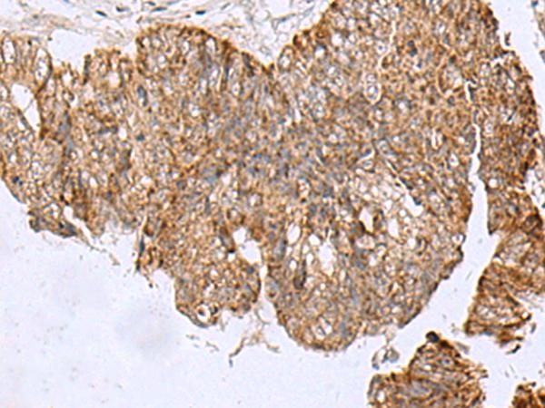 HCCS Antibody - Immunohistochemistry of paraffin-embedded Human colorectal cancer tissue  using HCCS Polyclonal Antibody at dilution of 1:110(×200)