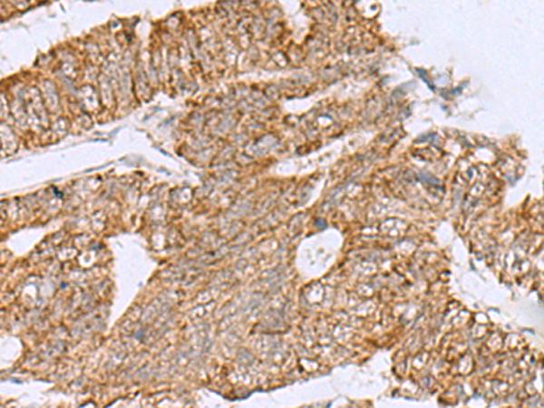 HCCS Antibody - Immunohistochemistry of paraffin-embedded Human colorectal cancer tissue  using HCCS Polyclonal Antibody at dilution of 1:60(×200)