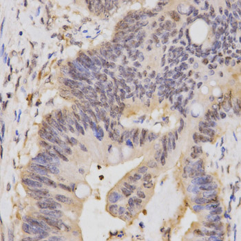 HCF1 / HCFC1 Antibody - Immunohistochemistry of paraffin-embedded human rectal cancer tissue.