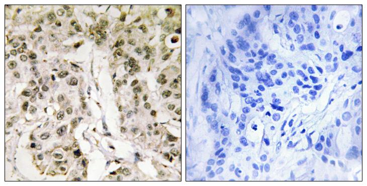 HCF1 / HCFC1 Antibody - Peptide - + Immunohistochemistry analysis of paraffin-embedded human breast carcinoma tissue, using HCFC1 antibody.