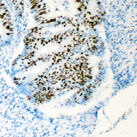 HCF1 / HCFC1 Antibody - Immunohistochemical analysis of HCFC1 staining in human colon cancer formalin fixed paraffin embedded tissue section. The section was pre-treated using heat mediated antigen retrieval with sodium citrate buffer (pH 6.0). The section was then incubated with the antibody at room temperature and detected using an HRP conjugated compact polymer system. DAB was used as the chromogen. The section was then counterstained with hematoxylin and mounted with DPX.