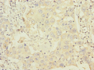 HCFC1R1 / HPIP Antibody - Immunohistochemistry of paraffin-embedded human liver cancer using HCFC1R1 Antibody at dilution of 1:100