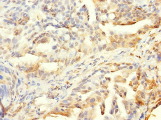 HCFC1R1 / HPIP Antibody - Immunohistochemistry of paraffin-embedded human lung cancer using HCFC1R1 Antibody at dilution of 1:100
