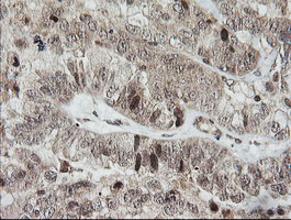 HCFC2 Antibody - IHC of paraffin-embedded Adenocarcinoma of Human ovary tissue using anti-HCFC2 mouse monoclonal antibody.