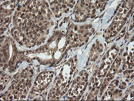 HCFC2 Antibody - IHC of paraffin-embedded Carcinoma of Human thyroid tissue using anti-HCFC2 mouse monoclonal antibody.