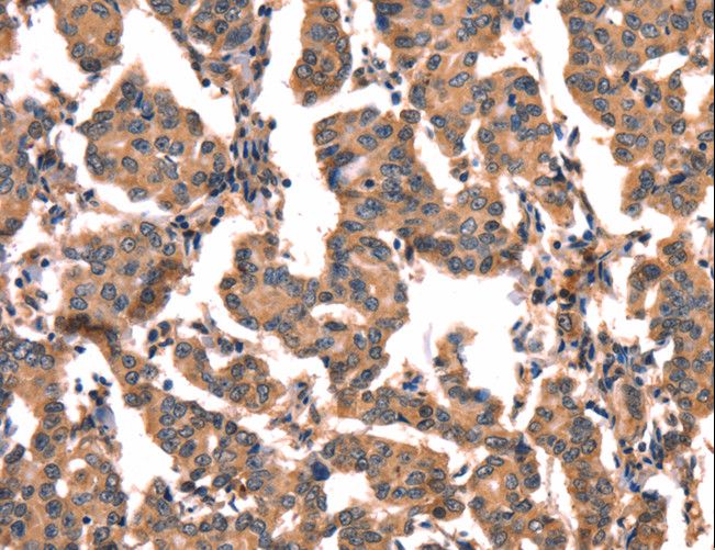 hCG / Chorionic Gonadotropin Antibody - Immunohistochemistry of paraffin-embedded Human liver cancer using CGA Polyclonal Antibody at dilution of 1:65.