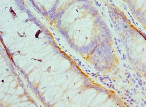 HCK Antibody - Immunohistochemistry of paraffin-embedded human colon cancer using antibody at 1:100 dilution.