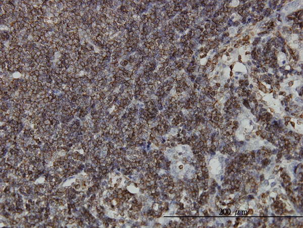 HCLS1 Antibody - Immunoperoxidase of monoclonal antibody to HCLS1 on formalin-fixed paraffin-embedded human lymph node. [antibody concentration 3 ug/ml]