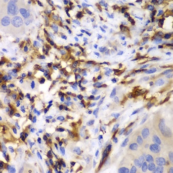 HCLS1 Antibody - Immunohistochemistry of paraffin-embedded human liver cancer tissue.