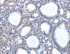 HCN1 Antibody - Immunohistochemistry of paraffin-embedded Human thyroid cancer using HCN1 Polyclonal Antibody at dilution of 1:50.