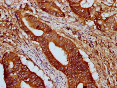 HCN1 Antibody - Immunohistochemistry Dilution at 1:500 and staining in paraffin-embedded human colon cancer performed on a Leica BondTM system. After dewaxing and hydration, antigen retrieval was mediated by high pressure in a citrate buffer (pH 6.0). Section was blocked with 10% normal Goat serum 30min at RT. Then primary antibody (1% BSA) was incubated at 4°C overnight. The primary is detected by a biotinylated Secondary antibody and visualized using an HRP conjugated SP system.