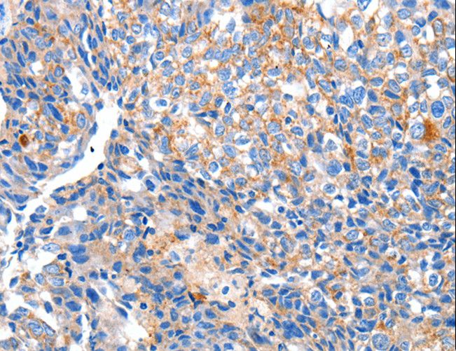 HCN2 Antibody - Immunohistochemistry of paraffin-embedded Human ovarian cancer using HCN2 Polyclonal Antibody at dilution of 1:80.