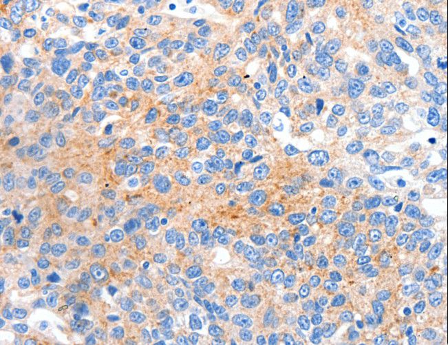 HCN2 Antibody - Immunohistochemistry of paraffin-embedded Human ovarian cancer using HCN2 Polyclonal Antibody at dilution of 1:80.