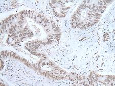 HCRT / Orexin Antibody - Immunohistochemistry of paraffin-embedded Human colorectal cancer tissue  using HCRT Polyclonal Antibody at dilution of 1:25(×200)