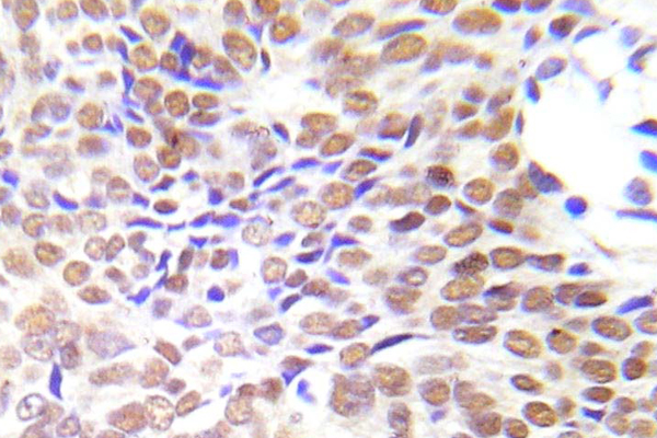 HDAC1 Antibody - Immunohistochemistry analysis of HDAC1 antibody in paraffin-embedded human lung adenocarcinoma tissue.