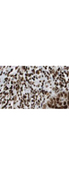 HDAC1 Antibody - Immunohistochemistry of rabbit Anti-HDAC-1 Antibody. Tissue: human lung tissue. Fixation: formalin fixed paraffin embedded. Antigen retrieval: not required. Primary antibody: HDAC-1 antibody at 10 µg/mL for 1 h at RT. Secondary antibody: Peroxidase rabbit secondary antibody at 1:10,000 for 45 min at RT. Localization: HDAC-1 is nuclear. Staining: HDAC-1 as brown color indicates presence of protein, blue color shows cell nuclei.