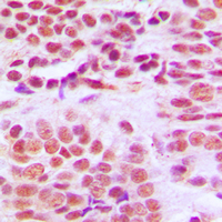 HDAC1 Antibody - Immunohistochemical analysis of Histone Deacetylase 1 staining in human breast cancer formalin fixed paraffin embedded tissue section. The section was pre-treated using heat mediated antigen retrieval with sodium citrate buffer (pH 6.0). The section was then incubated with the antibody at room temperature and detected using an HRP conjugated compact polymer system. DAB was used as the chromogen. The section was then counterstained with hematoxylin and mounted with DPX.
