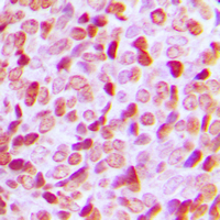 HDAC1 Antibody - Immunohistochemical analysis of Histone Deacetylase 1 staining in human prostate cancer formalin fixed paraffin embedded tissue section. The section was pre-treated using heat mediated antigen retrieval with sodium citrate buffer (pH 6.0). The section was then incubated with the antibody at room temperature and detected using an HRP conjugated compact polymer system. DAB was used as the chromogen. The section was then counterstained with hematoxylin and mounted with DPX.