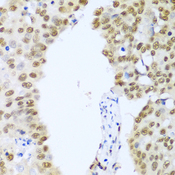 HDAC1 Antibody - Immunohistochemistry of paraffin-embedded human lung cancer using HDAC1 antibodyat dilution of 1:100 (40x lens).