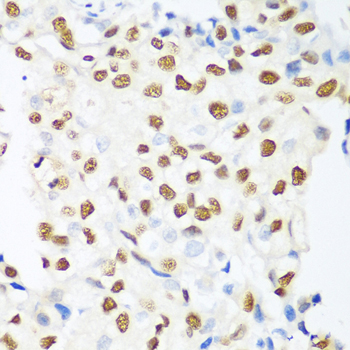 HDAC1 Antibody - Immunohistochemistry of paraffin-embedded human prostate cancer using HDAC1 antibodyat dilution of 1:100 (40x lens).