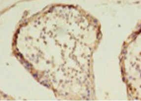 HDAC1 Antibody - Immunohistochemistry of paraffin-embedded human colon cancer using HDAC1 Antibody at dilution of 1: 100