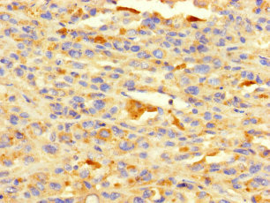 HDAC1 Antibody - Immunohistochemistry of paraffin-embedded human melanoma using HDAC1 Antibody at dilution of 1:100