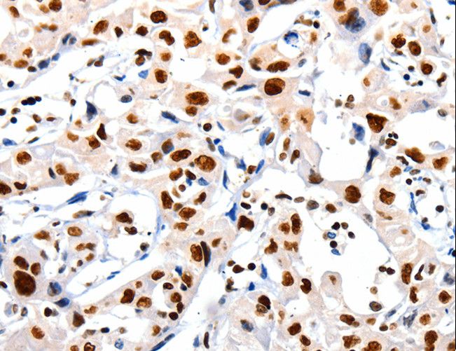 HDAC1 Antibody - Immunohistochemistry of paraffin-embedded Human lung cancer using HDAC1 Polyclonal Antibody at dilution of 1:20.