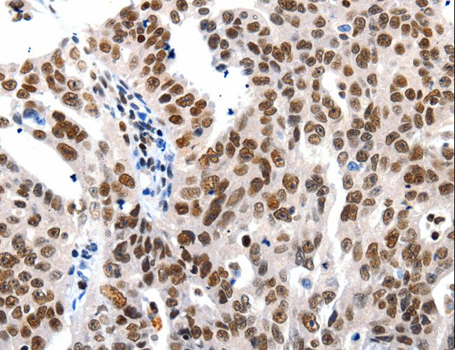 HDAC1 Antibody - Immunohistochemistry of paraffin-embedded Human ovarian cancer using HDAC1 Polyclonal Antibody at dilution of 1:20.
