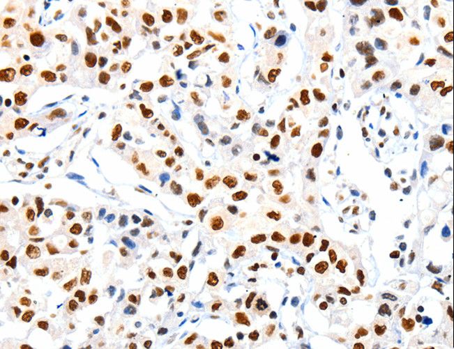HDAC1 Antibody - Immunohistochemistry of paraffin-embedded Human lung cancer using HDAC1 Polyclonal Antibody at dilution of 1:20.