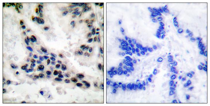 HDAC1 Antibody - Peptide - + Immunohistochemical analysis of paraffin-embedded human lung carcinoma tissue using HDAC1 antibody.