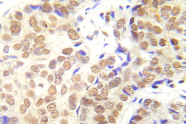 HDAC1 Antibody - Immunohistochemistry analysis of phospho-HDAC1 (Phospho-Ser421/423) antibody in paraffin-embedded human lung adenocarcinoma tissue.