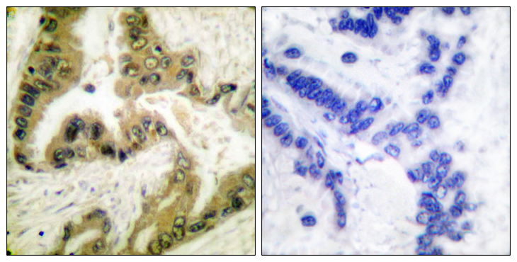 HDAC10 Antibody - Immunohistochemistry analysis of paraffin-embedded human lung carcinoma tissue, using HDAC10 Antibody. The picture on the right is blocked with the synthesized peptide.