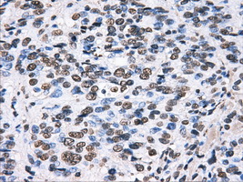 HDAC10 Antibody - IHC of paraffin-embedded Carcinoma of bladder tissue using anti-HDAC10 mouse monoclonal antibody. (Dilution 1:50).
