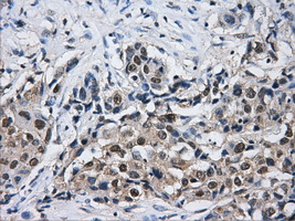 HDAC10 Antibody - IHC of paraffin-embedded Adenocarcinoma of breast tissue using anti-HDAC10 mouse monoclonal antibody. (Dilution 1:50).