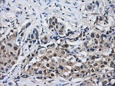 HDAC10 Antibody - IHC of paraffin-embedded Adenocarcinoma of breast tissue using anti-HDAC10 mouse monoclonal antibody. (Dilution 1:50).
