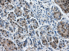 HDAC10 Antibody - IHC of paraffin-embedded Carcinoma of liver tissue using anti-HDAC10 mouse monoclonal antibody. (Dilution 1:50).