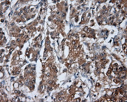 HDAC10 Antibody - IHC of paraffin-embedded Carcinoma of liver tissue using anti-HDAC10 mouse monoclonal antibody. (Dilution 1:50).